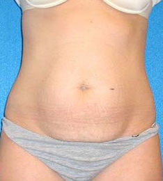 Tummy Tuck