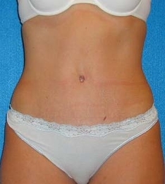 Tummy Tuck