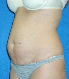 Tummy Tuck