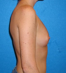 Breast Augmentation