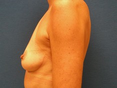 Breast Augmentation