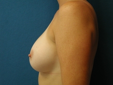 Breast Augmentation