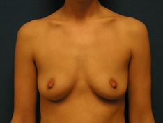 Breast Augmentation