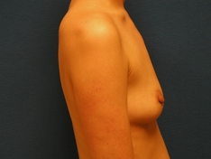 Breast Augmentation