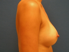 Breast Augmentation