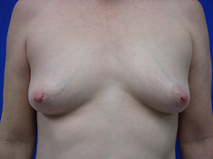 Breast Augmentation