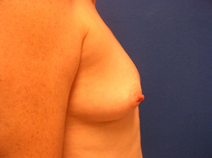 Breast Augmentation