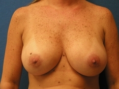 Breast Augmentation