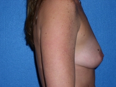 Breast Augmentation