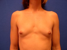 Breast Augmentation