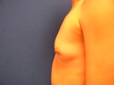 Breast Augmentation