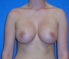 Breast Augmentation