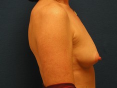 Breast Augmentation