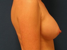 Breast Augmentation