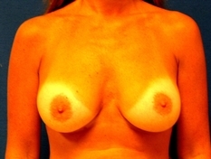 Breast Augmentation