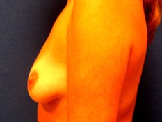 Breast Augmentation