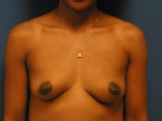 Breast Augmentation