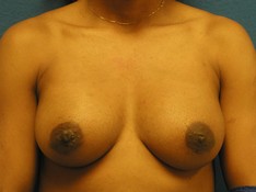 Breast Augmentation