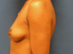 Breast Augmentation