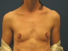 Breast Augmentation