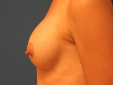 Breast Augmentation