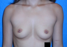 Breast Augmentation