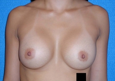 Breast Augmentation