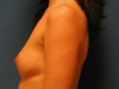 Breast Augmentation