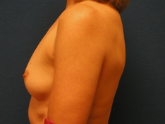 Breast Augmentation