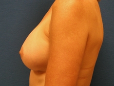 Breast Augmentation