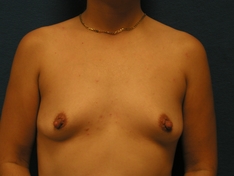 Breast Augmentation