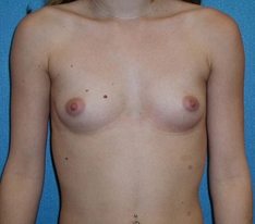 Breast Augmentation