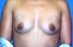 Breast Augmentation