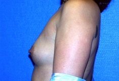 Breast Augmentation