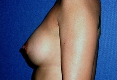 Breast Augmentation