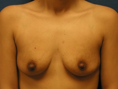 Breast Augmentation