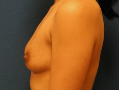 Breast Augmentation