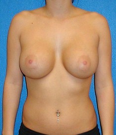 Breast Augmentation