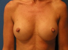 Breast Augmentation