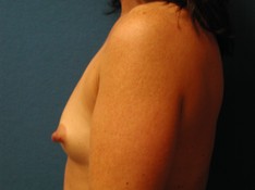 Breast Augmentation