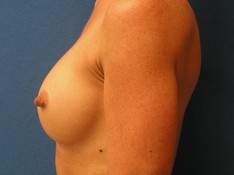 Breast Augmentation