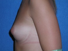 Breast Augmentation