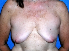 Breast Augmentation