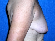 Breast Augmentation