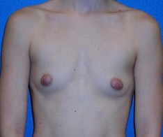 Breast Augmentation