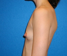 Breast Augmentation