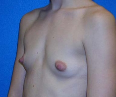 Breast Augmentation