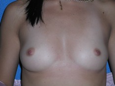 Breast Augmentation