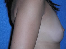 Breast Augmentation