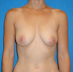 Breast Augmentation